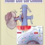 Renal Cell Carcinoma