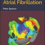 Understanding Atrial Fibrillation